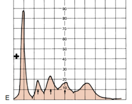 <p>Determine the condition of the patient given the serum electrophoresis graph</p><img src="https://knowt-user-attachments.s3.amazonaws.com/06ad01c7-2b1c-4e2b-9f0e-e291d103a22a.png" data-width="100%" data-align="center" alt="knowt flashcard image"><p>A. Inflammation</p><p>B. Liver Cirrhosis</p><p>C. Nephrotic Syndrome</p><p>D. Liver Cirrhosis</p><p>E. NOTA</p>