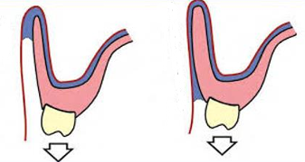 <p>Compare the denture flange, which has the better seal?</p><p>where else in an denture do you need a good seal</p>