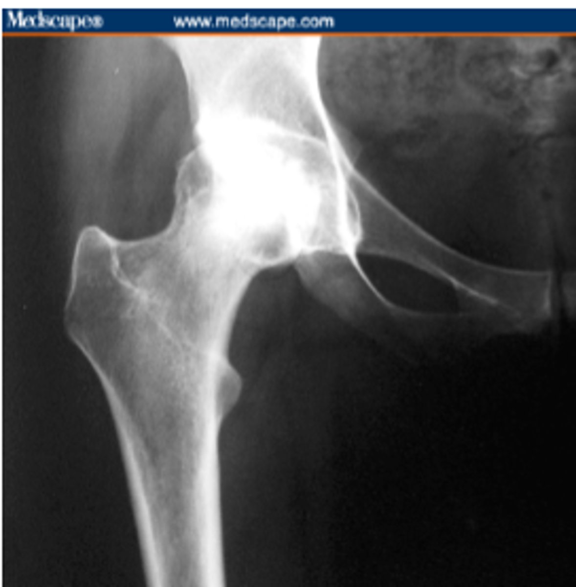 <p>involves death of the bone tissue due to compromised blood supply</p><p>*can be post surgery, due to trauma, corticosteroid use, alcohol abuse, in deep sea divers, or may occur with no known pathology</p><p>STRUCTURE--&gt; femoral head</p><p>FUNCTIONAL DEFICITS--&gt; pain, limited ROM, joint collapse/destruction</p><p>COMPENSATORY MOVEMENTS--&gt; shift body weight to limit force through the affected region (gluteus medius gait), limit activity</p>