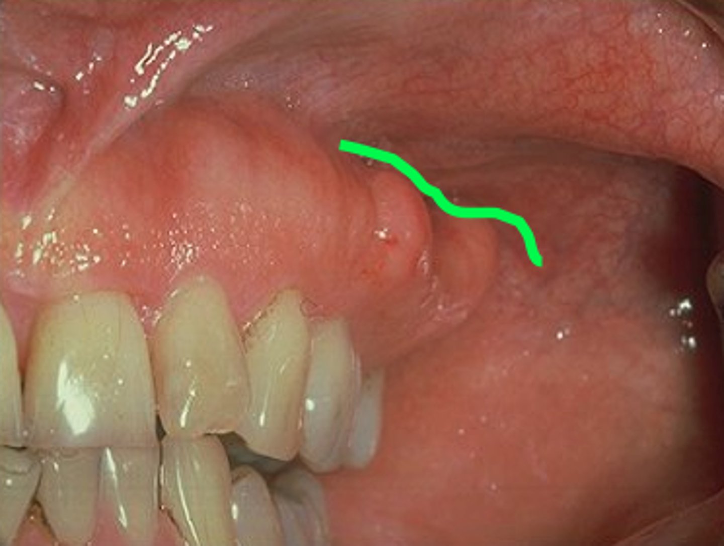 <p>The point where the lips/cheeks turns to go towards the gingival tissue</p>