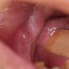 <p>fistula</p>
