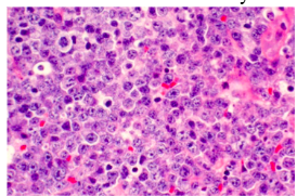 <p>-diffuse sheet of inflammatory cells</p>
