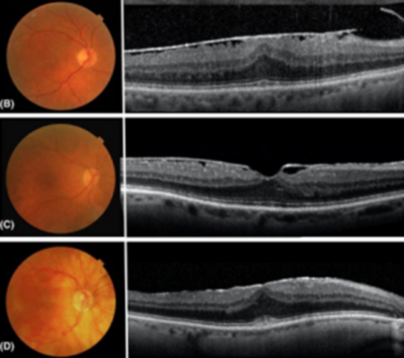 <p>macular pucker = distorted retina = blur, distortion</p>