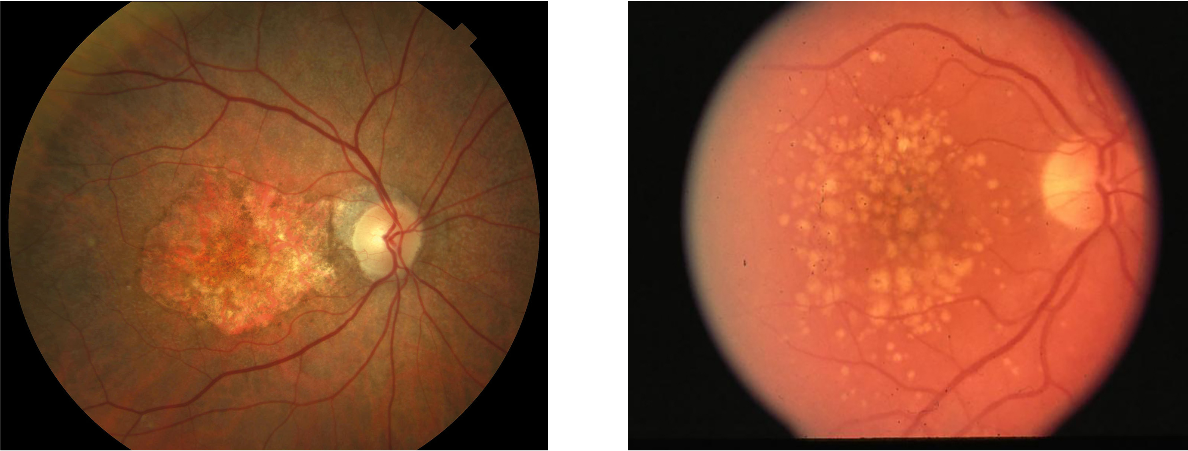 <p>Fundus photography would typically show drusen, retinal pigment epithelial changes, and/or geographic atrophy. </p>