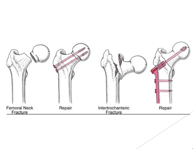 <p>Fracture/ dislocation</p>