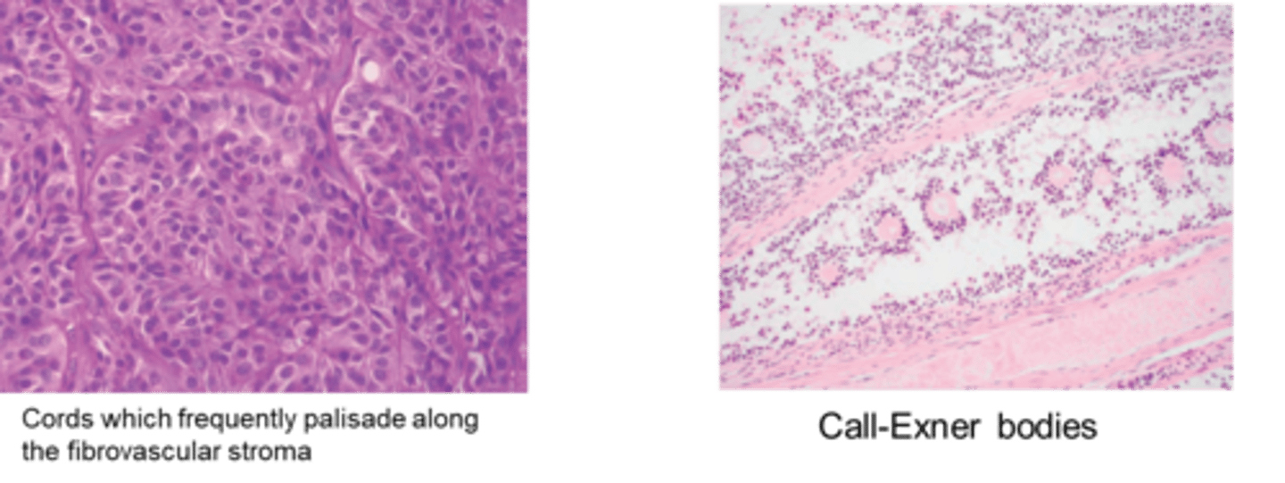 <p>A variety of patterns may occur in different areas: solid sheets, islands, cords, trabeculae, nests. Sometimes presence of Call Exner bodies.</p>