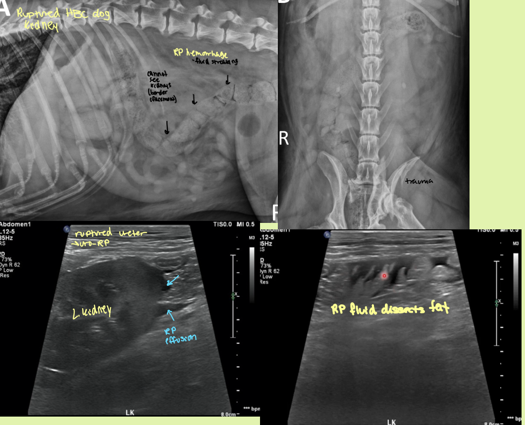 <p>ruptured kidney</p>