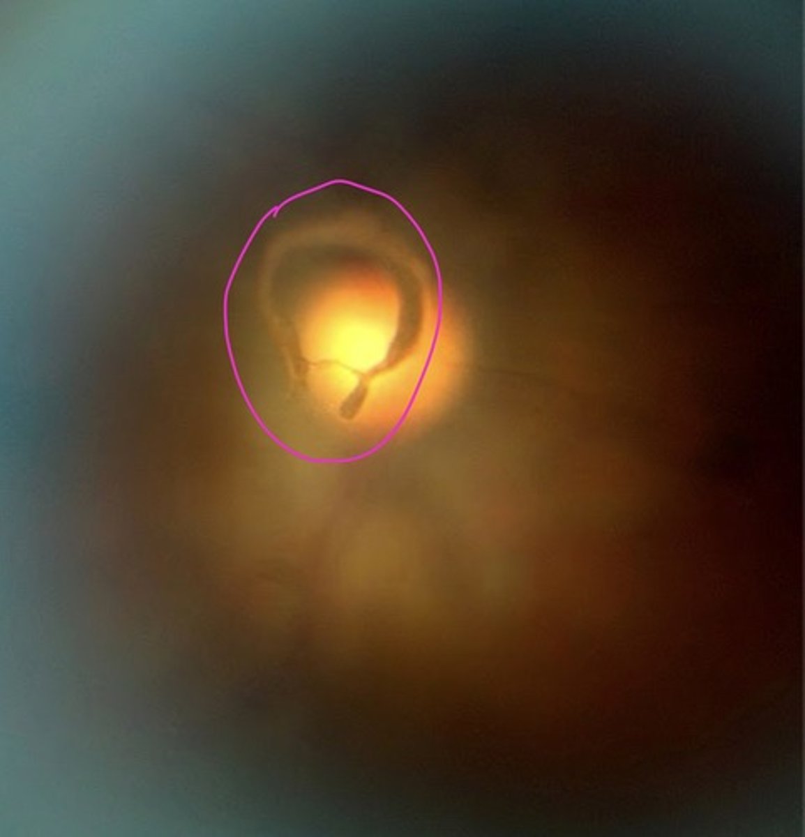 <p>sign of PVD</p><p>-where PVD pulls away from around the optic disc</p>