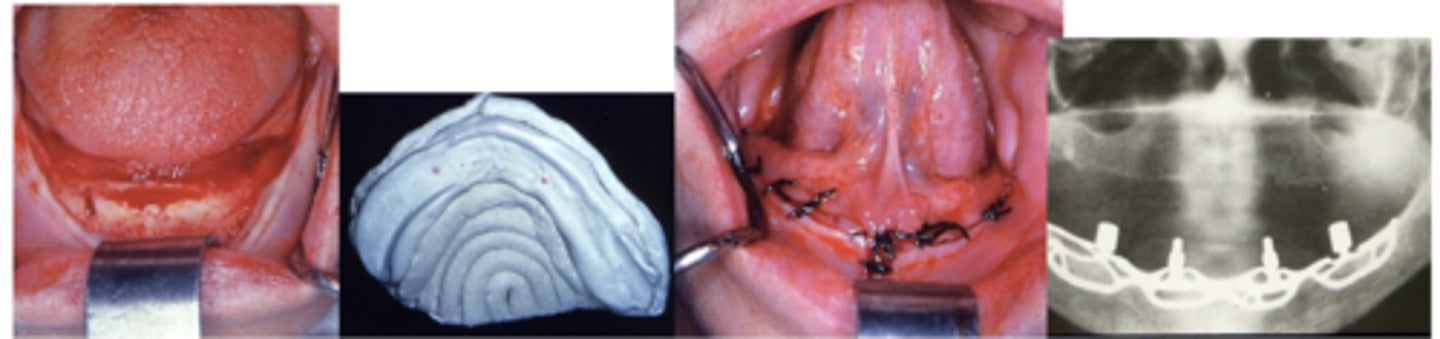 <p>What type of implant?</p>