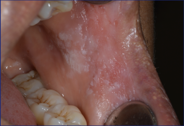 <p>White → due to epithelial thickening, various forms</p>