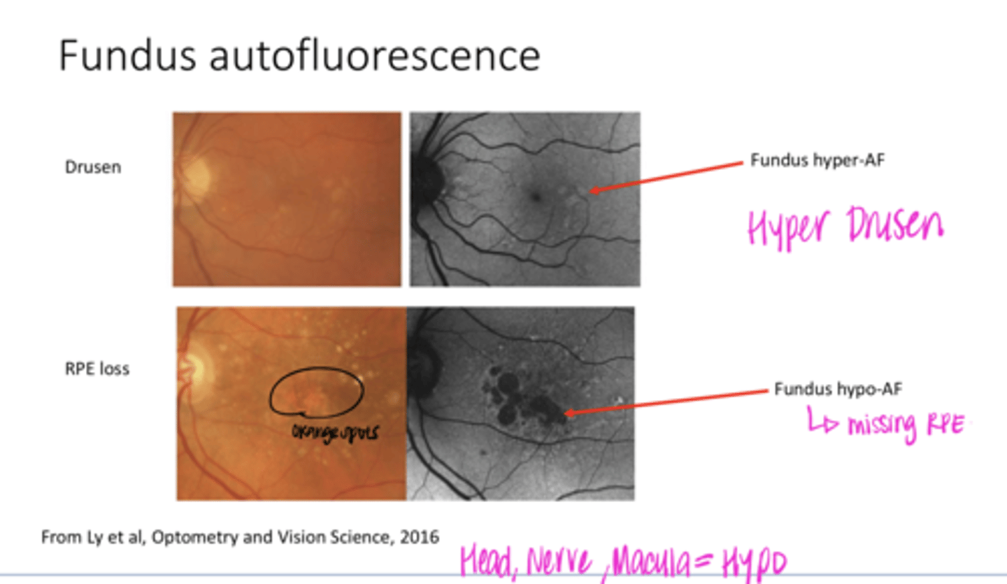 <p>What is orange color on fundus photo mean?</p>