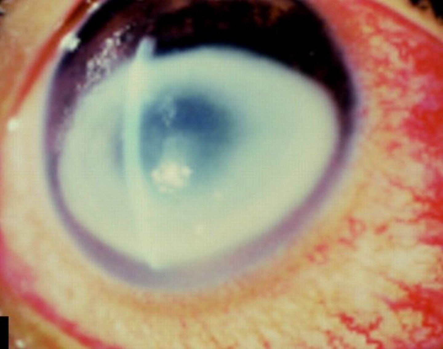 <p>Due to corneal toxicity, ______________________ of a topical anesthetic is a contraindication due to the possibility of corneal scarring which can lead to permanent vision loss.</p>
