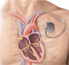 <p><strong>When educating a patient about to undergo a pacemaker insertion, the nurse explains the normal phases of cardiac muscle tissue. During the repolarization phase, the nurse will stress that membranes must be repolarized before they can be reexcited. Within the cell, the nurse understands that</strong></p><p>A) potassium channels open while sodium channels close, causing repolarization to the resting state.</p><p>B) the influx of calcium is the primary stimulus for the repolarization of cardiac tissue.</p><p>C) only the electrical activity within the heart will determine when repolarization occurs.</p><p>D) the cell membranes need to stay calm resulting in muscle tissue</p><p>becoming refractive.</p>
