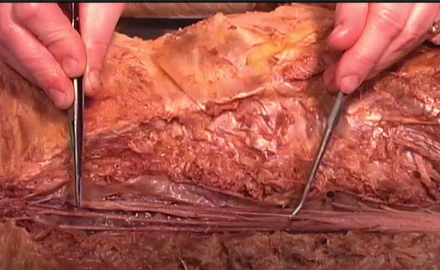 <p>Which structure is being shown here?</p><p>Erectus spinus</p><p>Spine</p><p>Latissimus dorsi</p><p>Filum terminale</p>