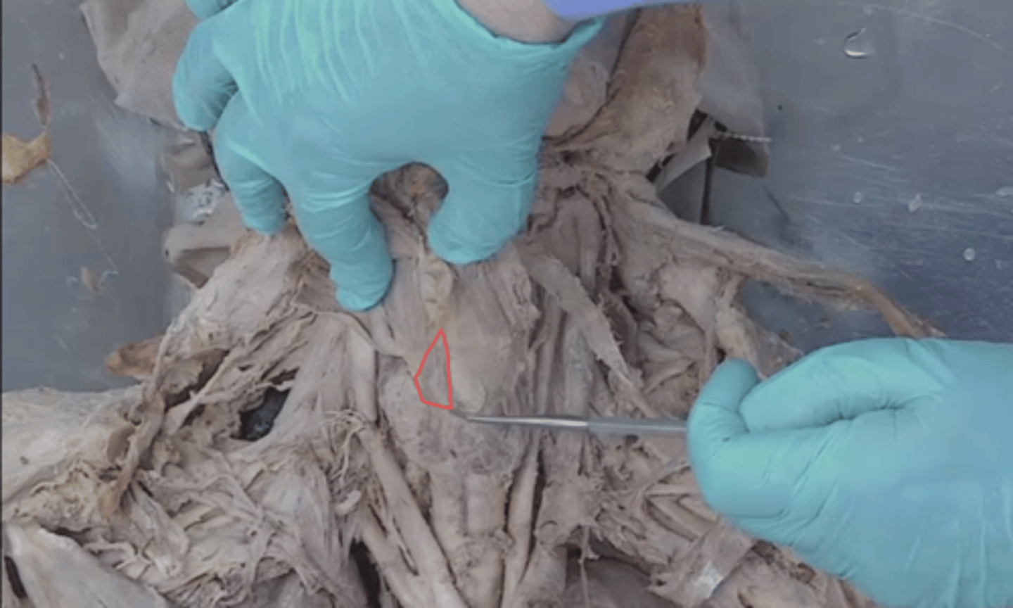 <p>identify this structure (50% have it)</p>