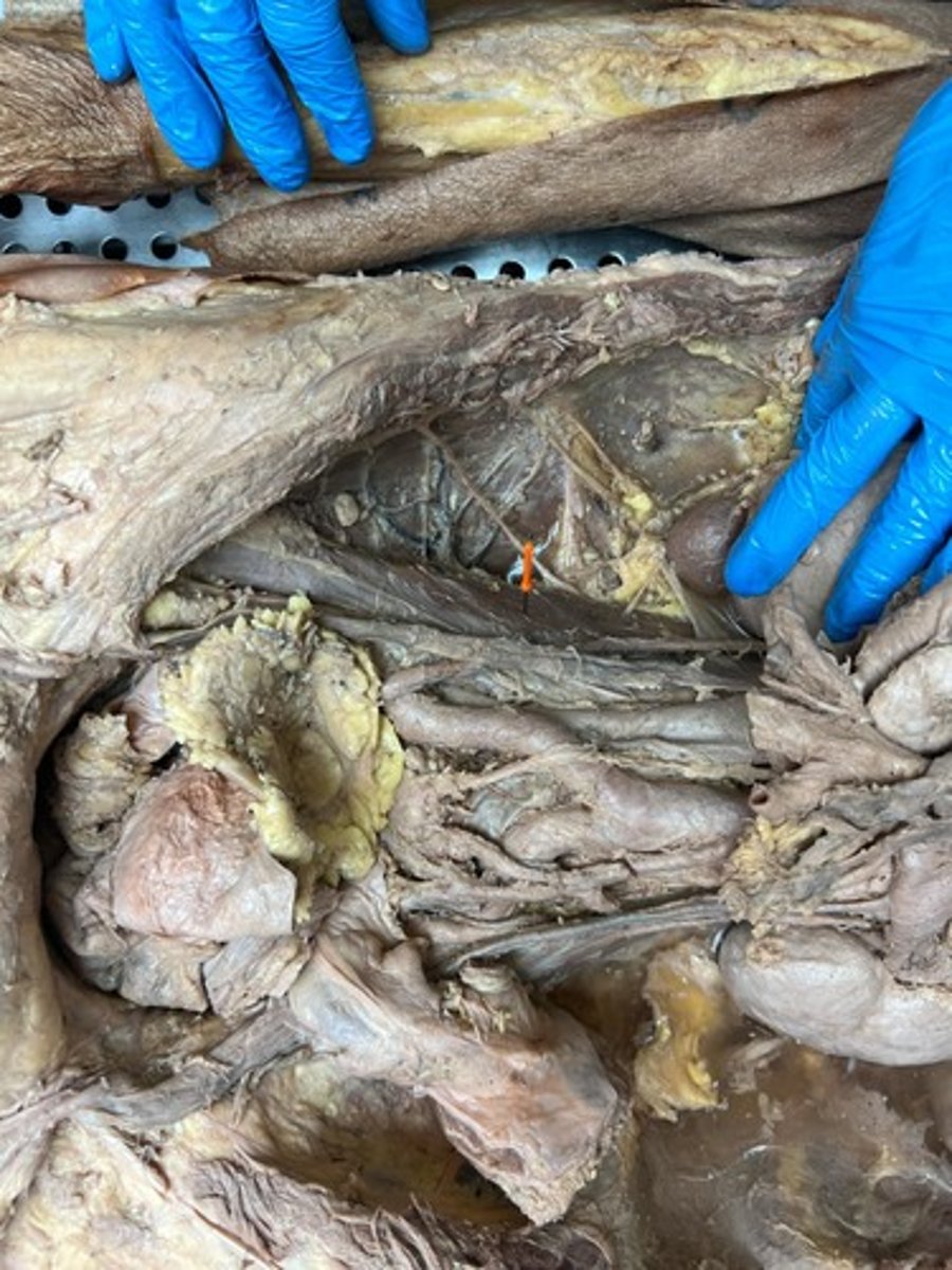<p>psoas major muscle</p>