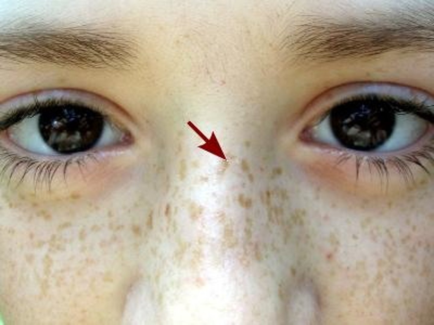 <p>Flat discolored lesion (freckle/age spot)</p>