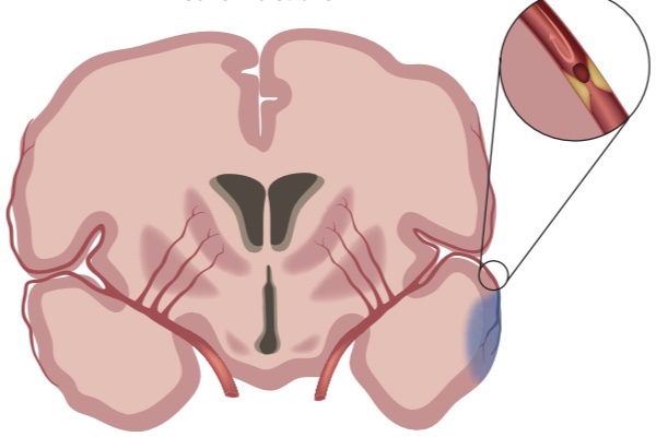 <p>Blockage or clot</p>