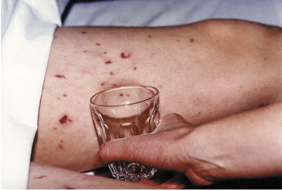 <p>-Typical purpura ( blood vessels get inflamed, they can bleed into the skin, causing a reddish-purple rash)</p><p>-Petechiae rash -- round spots that appear on the skin as a result of bleeding</p>