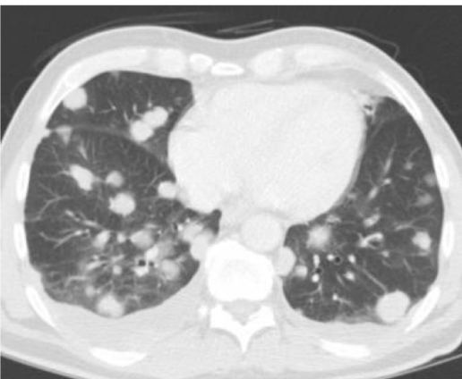 <p>benign or malignant?</p>