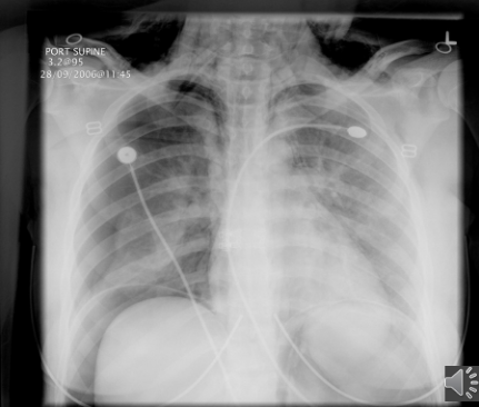 <p>PT presents with bulging skin around the neck area<br><br>What pathology is present?</p>