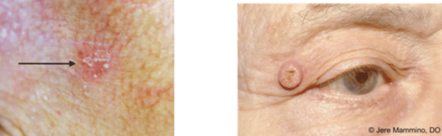 <p>actinic keratosis</p><p>keratoacanthoma</p>