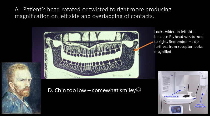 <p>A. Head rotated or twisted to right more</p>