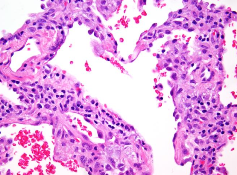 <p>Neumonía intersticial inespecífica tipo:</p>