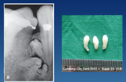 <p>cluster of teeth, common in anterior maxilla </p>