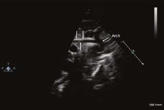 <p><span>A severe congenital heart defect marked by underdevelopment of the left side of the heart, including the left ventricle, aortic/mitral valves, and ascending aorta. It is a ductal-dependent lesion, requiring a patent ductus arteriosus for systemic blood flow. Pulmonary venous return shunts primarily through the atrial septum to the right heart, which then supplies both pulmonary and systemic circulation.</span></p>