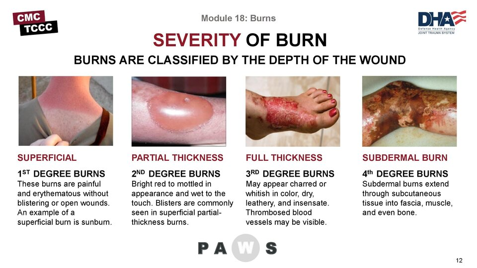 <p>1 - epidermis, superficial layer: redness, pain, mild swelling </p><p>2 - epidermis + dermis, partial thickness: redness, blisters, pain, swelling </p><p>3 - epidermis + dermis + hypodermis, all layers of skin exposing muscles and bone: white, charred, leathery, numb due to nerve damage </p><p>4  - all layers damaged possibly even organs, </p><p></p>