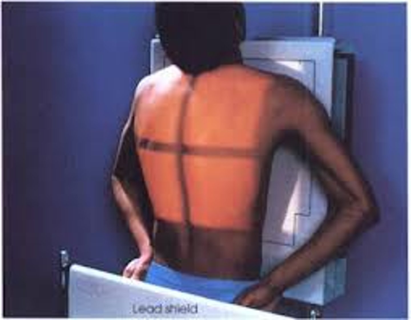 <p>posterior-anterior</p><p>-pt stands or sits upright with the chest against the film holder</p><p>-heart and lungs (normal chest x-ray)</p>