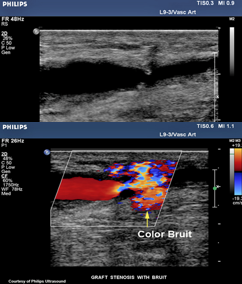 <p>Pt s/p in-situ bypass graft RLE</p><p>STAT ultrasound exam ordered with order indication as ‘bruit’</p><p>You take your machine portable to post-op recovery room to perform exam. You take these images. </p><p>1.Considering type of graft, what is possible finding? </p><p>2.What is color image information indicating? </p><p>3.Is color diagnostic? </p><p>4.What will your spectral Doppler most likely indicate? </p><p>5.Do these images explain clinical indication for exam? </p>