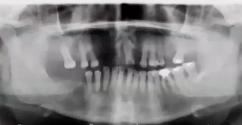 <p>what condition is associated with this radiographic finding </p>