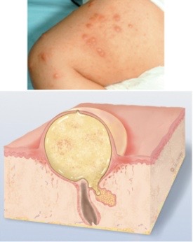 <p>cavity containing pus (turbid fluid) that is elevated and circumscribed</p><p>ex: acne </p>