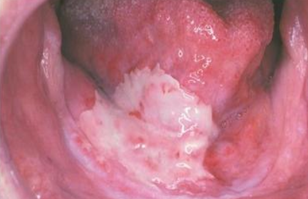 <p>What are the clinical manifestations of <strong>radiation</strong> treatment (antineoplastic)?</p>