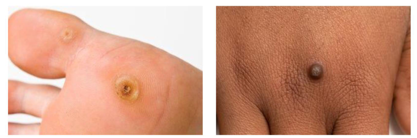 <ul><li><p>Small skin coloured excess growths of akin cause by human papilloma virus (HPV), stimulates basal cell division</p></li><li><p>Common in children, teenagers</p></li><li><p>Warts can appear anywhere on the skin, usually hands and feet</p></li><li><p>Verruca is a wart on the sole of the foot, underlying black dots</p></li><li><p>Transmitted by skin to skin contact, contact with contaminated surfaces</p></li></ul><p></p>