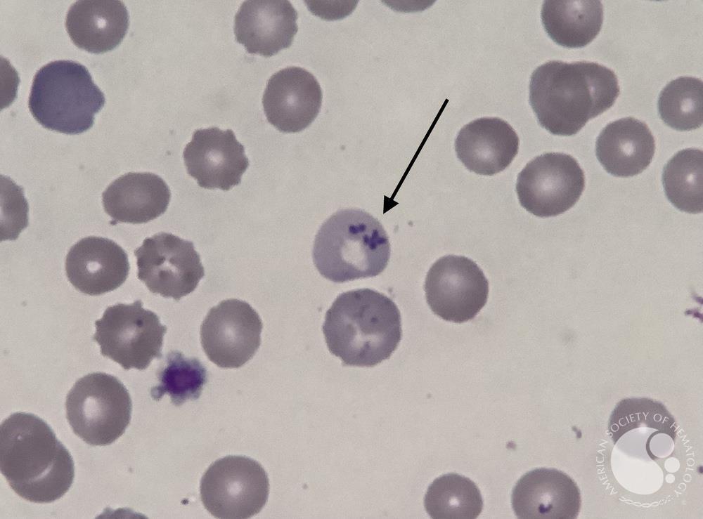 <ul><li><p>small, light purple beaded inclusions</p></li><li><p>seen in iron loading anemias (excessive iron)</p></li></ul><p></p>