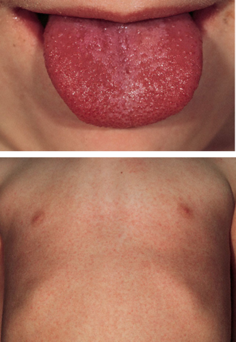 erythrogenic toxin from bacteriophage, sandpaper-like rash, strawberry tongue