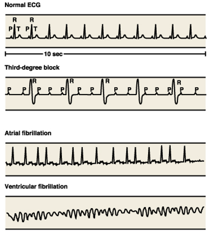 normal: typical P, QRS, T waves

third degree block: ventricles are not contracting

atrial fib: HB faster, p-wave gone, atria not contracting

ventricular fib: ventricles are fluttering, SA/AV node control is gone, receives local signals instead