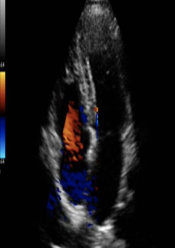 <p>What color Doppler artifact is demonstrated on the image? </p>