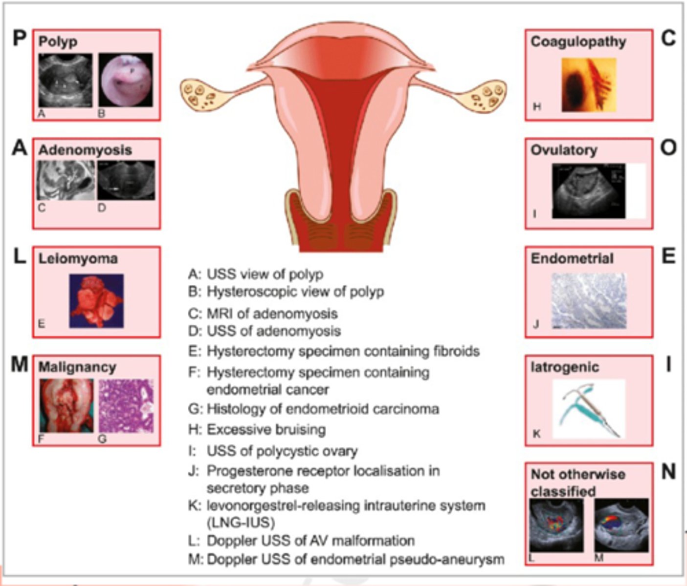 <p>-PALM-COEIN </p><p>structual causes </p><p>-polyp</p><p>-adenomyosis</p><p>-leiomyoma </p><p>-malignancy and hyperplasia</p><p>non-structural causes </p><p>-coagulopathy</p><p>-ovulatory dysfunction </p><p>-endometrial</p><p>-latrogenic</p><p>-not classified yet </p>