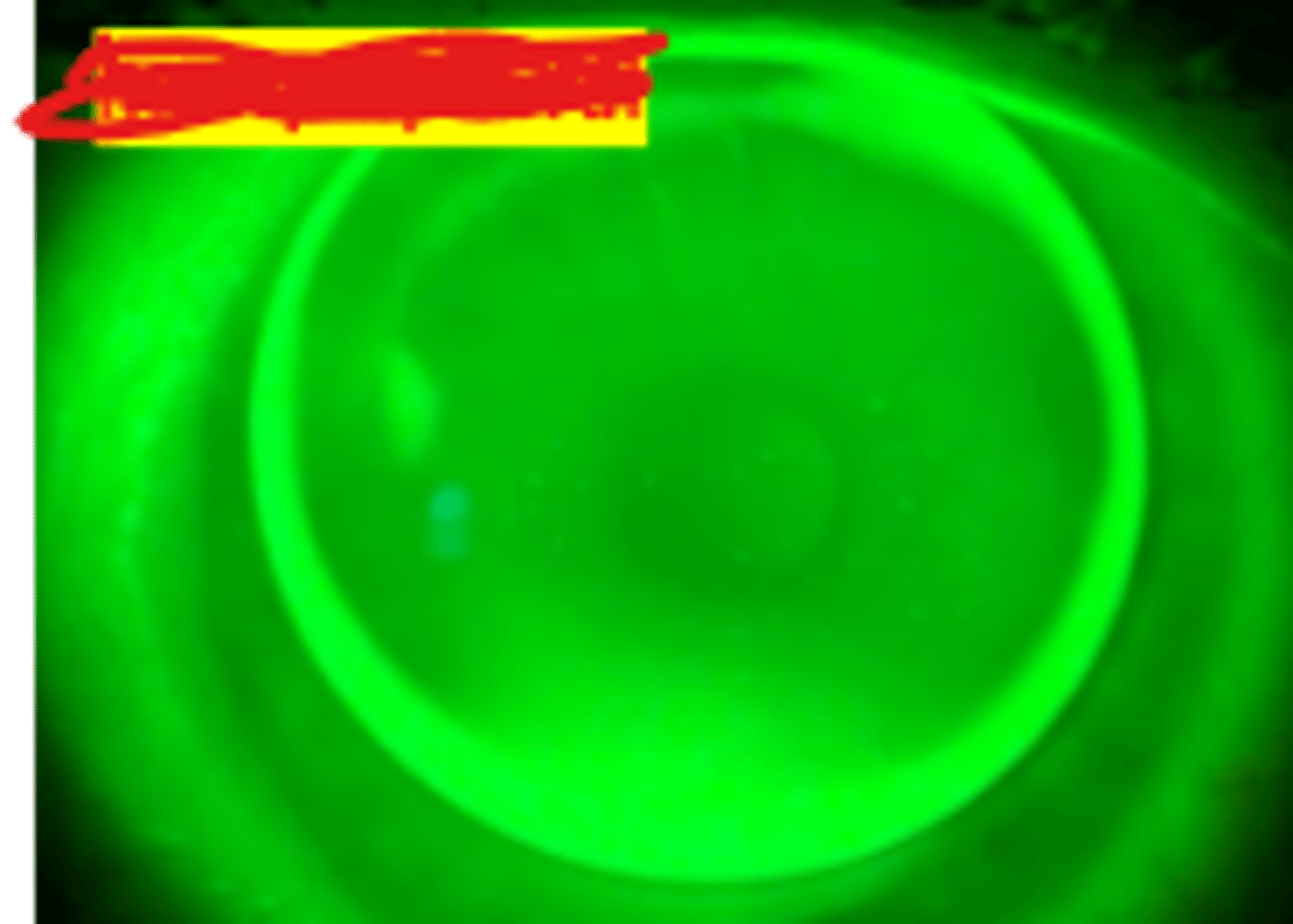 <p>GPCL lid interaction where the lens sits between the upper and lower lids most often in a central position, possibly slightly decentered. Is indicated in higher upper lids or tight eye lids.</p>