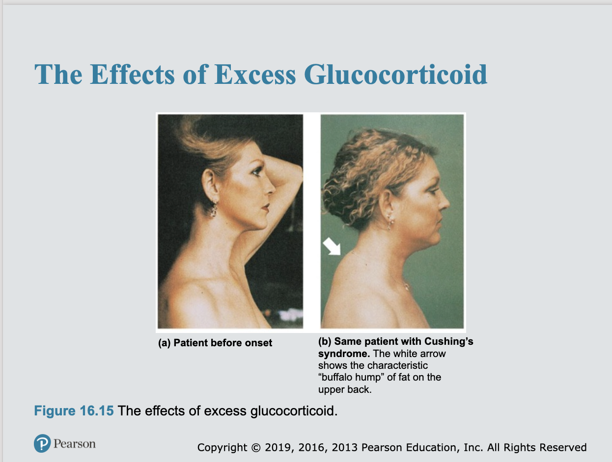 <ul><li><p>Usually involves deficits in both glucocorticoids and mineralocorticoids</p></li><li><p>Decrease in plasma glucose and Na<sup>+</sup> levels</p></li><li><p>Weight loss, severe dehydration, and hypotension are common</p></li><li><p>Treatment: corticosteroid replacement therapy</p></li><li><p>Early sign is characteristic bronzing of skin due to high levels of ACTH which triggers melanin production in melanocytes</p></li></ul><p></p>