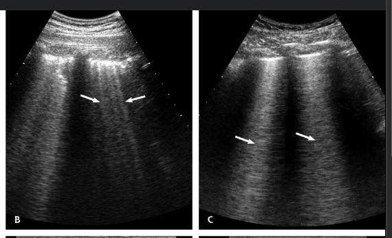 <p>What US finding are the lines pointing to? Are these normal findings?</p>