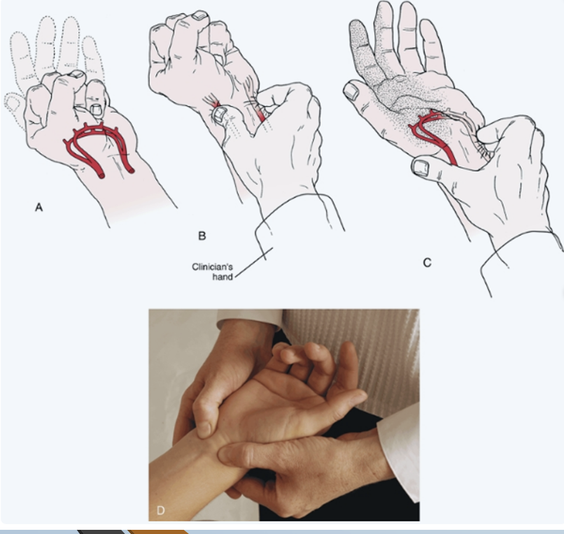 <p><span><strong>•Tests for:  </strong>Circulation of the Ulnar and radial artery</span></p><p><span><strong>•Positive sign:</strong></span></p><p><span>•Unequal or slow (6 seconds) flushing in the hand when the blood flow is allowed to return</span></p><p><span><strong>•Method:</strong></span></p><p><span>•Patient is asked to open and close the hand several times quickly</span></p><p><span>•Then patient squeezes hand tightly</span></p><p><span>•Therapist places thumb and index finger over radial and ulnar arteries compressing them</span></p><p><span>•Patient opens hand while therapist maintains pressure</span></p><p><span>•Then remove pressure from one artery and watch for flushing</span></p><p><span>•Repeat for other artery</span></p><p></p>