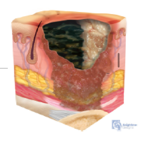 <p>Stage is unclear because we can’t tell the deepness/base of the wound d/t slough and eschar</p><ul><li><p>Full-thickness tissue loss </p></li></ul><p></p>
