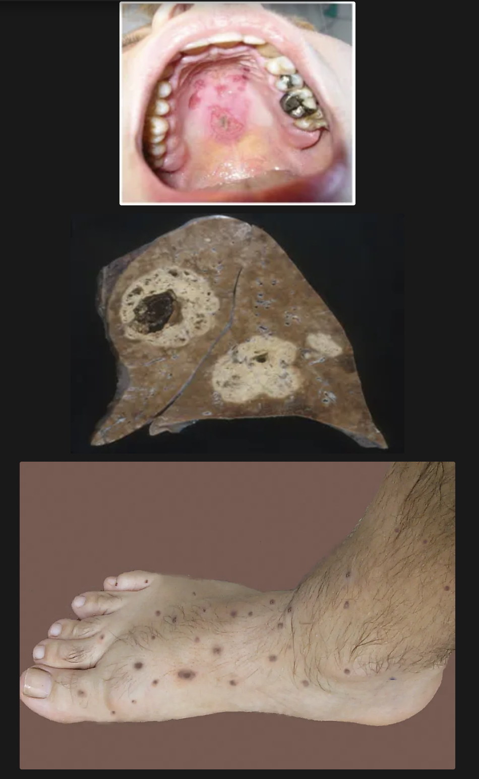 <ul><li><p>Fiebre</p></li><li><p>Rinorrea purulenta</p></li><li><p>Úlceras nasales</p></li><li><p>Dolor sinusal</p></li><li><p>Hemoptisis</p></li><li><p>Púrpura cutánea </p></li><li><p><strong>Sinusitis inflamatoria con granulomas mucosos o lesiones ulcerativas de nariz, paladar o faringe</strong></p></li></ul><p></p>