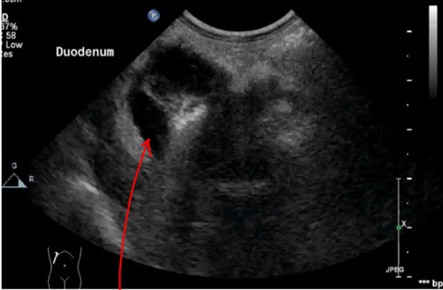 <p>are any layers present in this small intestine? is this abnormal or no? what is inside</p><p>?</p>