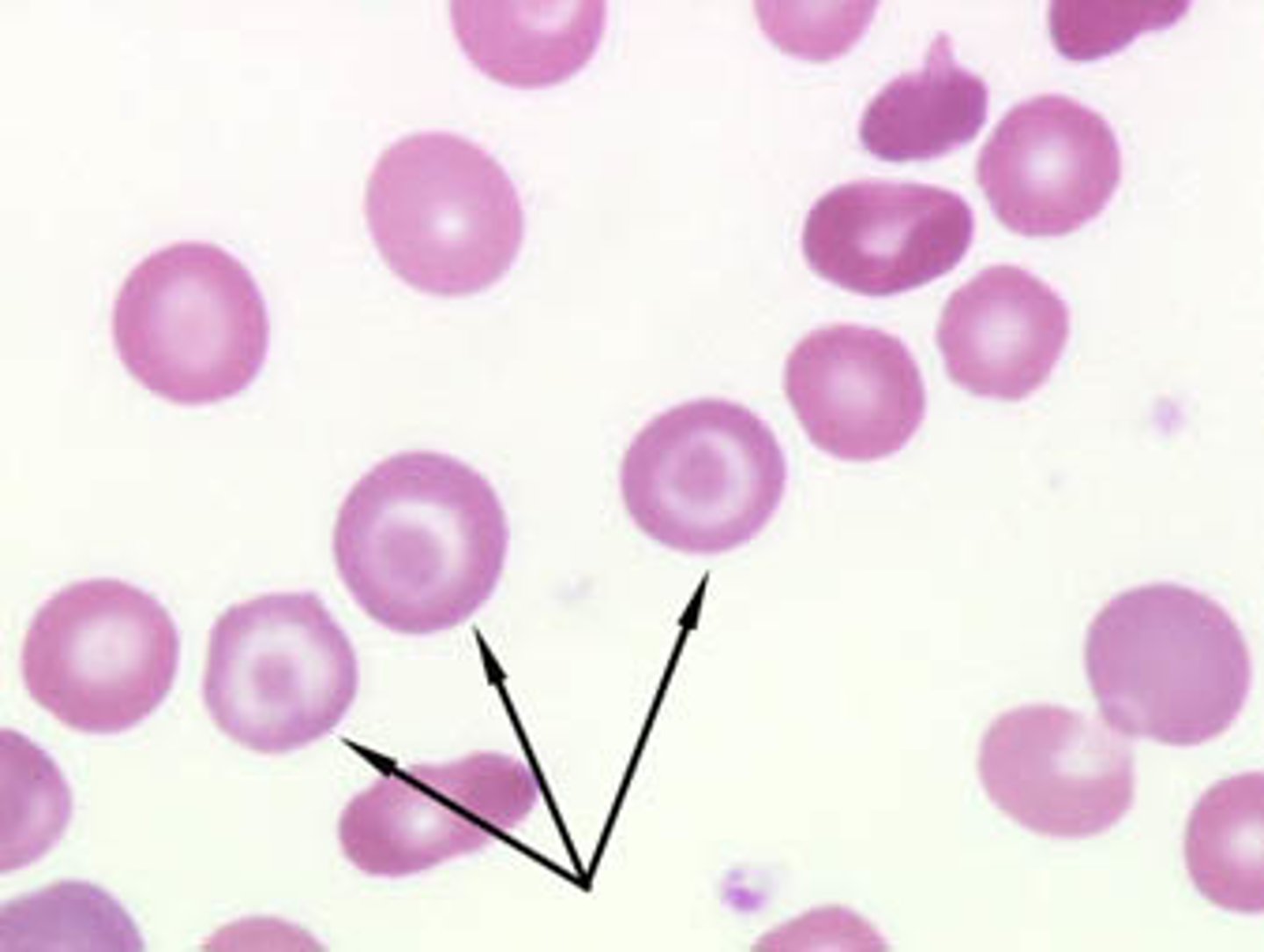 <p>cell with strongly staining area in the middle of the central pallor region</p><p>(cell shape)</p>